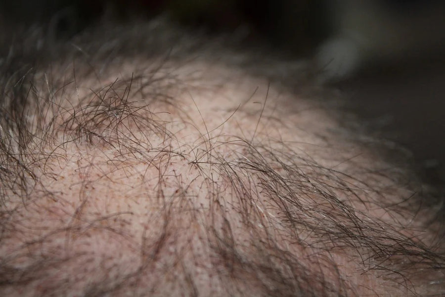 Causes of Hair Loss