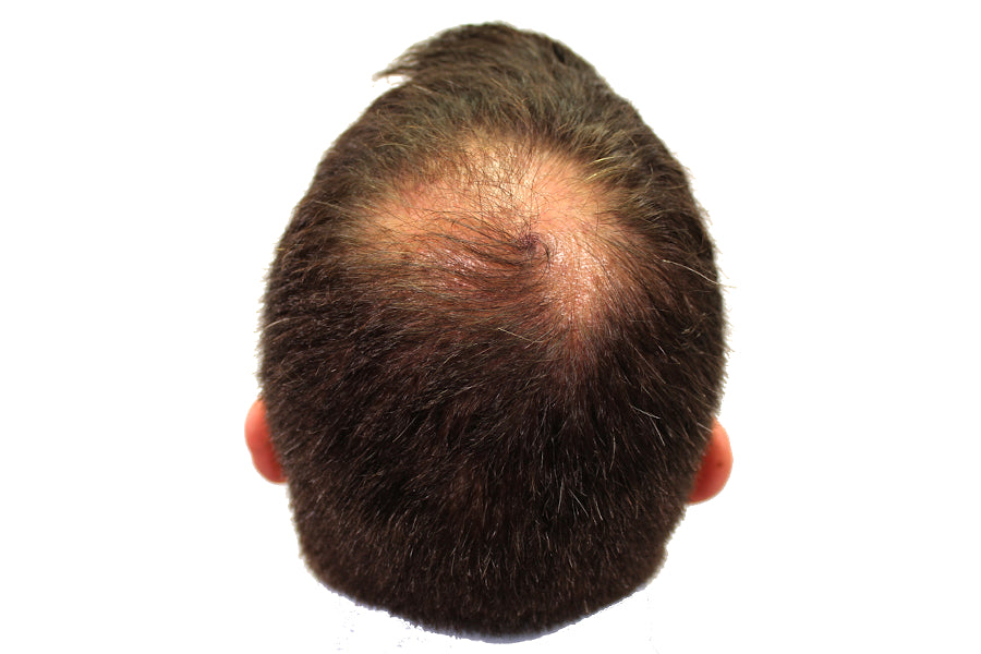 JAK Inhibitors – Could they treat your hair loss?