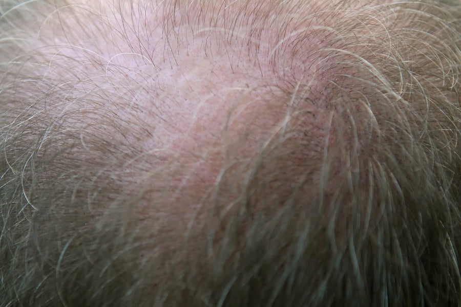 The Fascinating Fickle Follicle