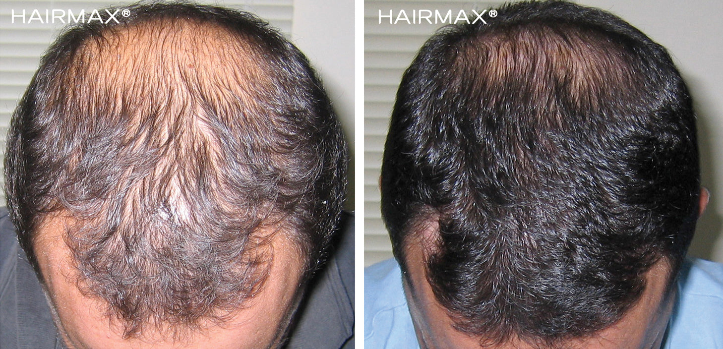 Nutrition for healthy hair and preventing hair loss